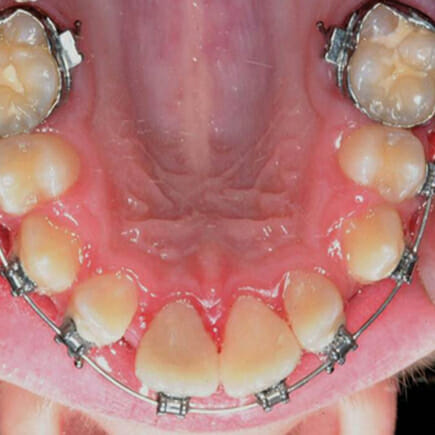 Metal Braces Vs Ceramic Braces: A Closer Look