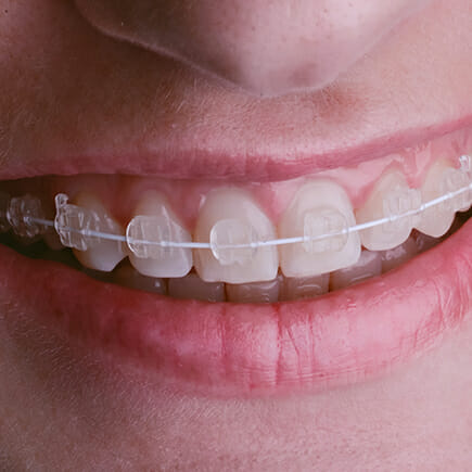 Metal Braces  San Antonio Orthodontics