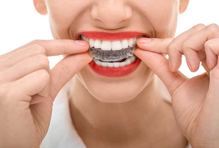 Choosing Invisalign